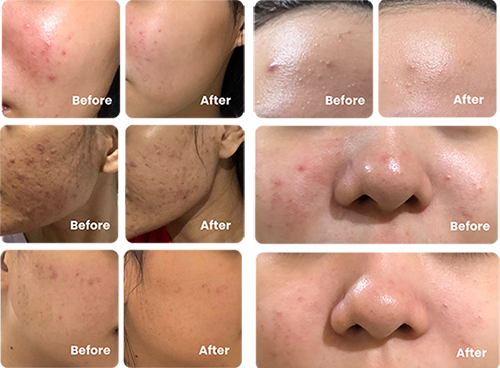Before After 3-in-1 Acne Treatment Serum