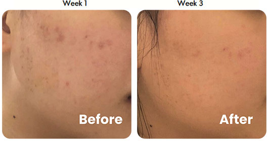 Testimonial 3-in-1 Acne Treatment Serum