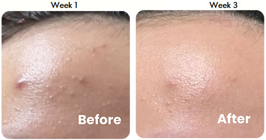 Testimonial 3-in-1 Acne Treatment Serum