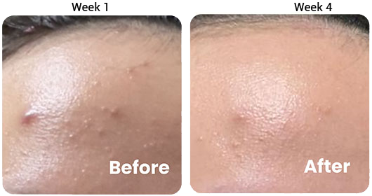 Testimonial 3-in-1 Acne Treatment Serum